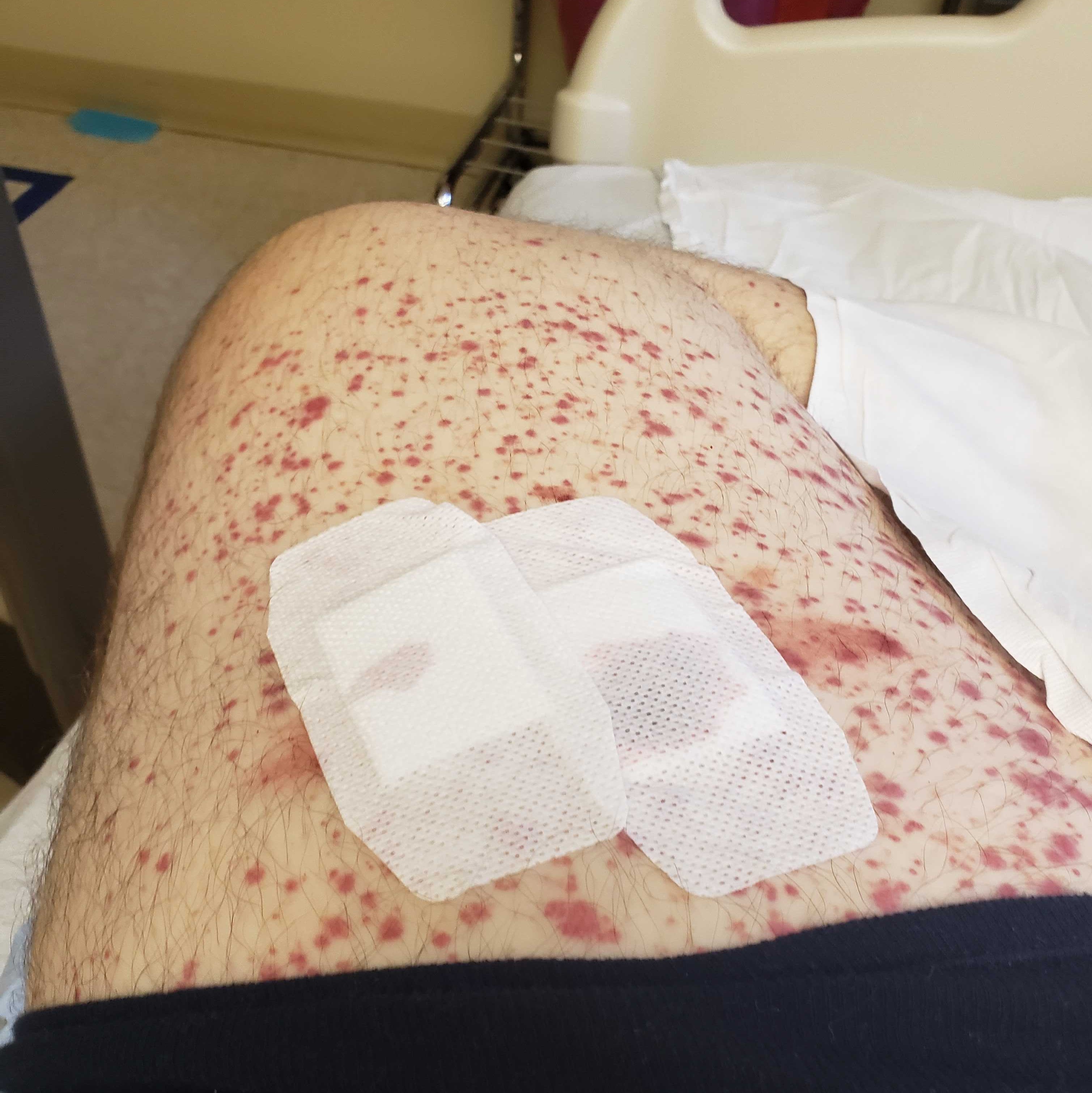 My thigh post-biopsy