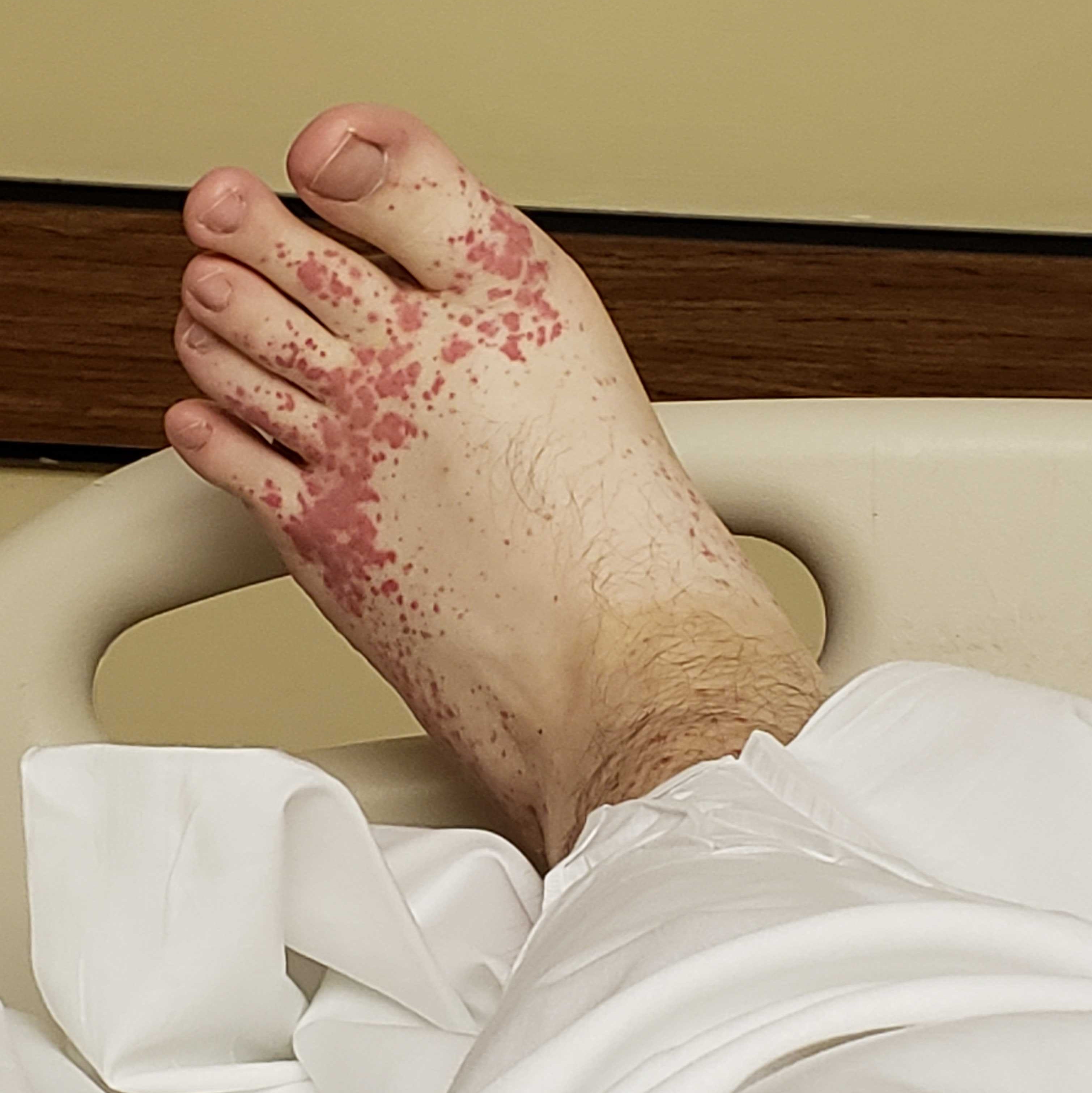 My foot while laying in my hospital bed