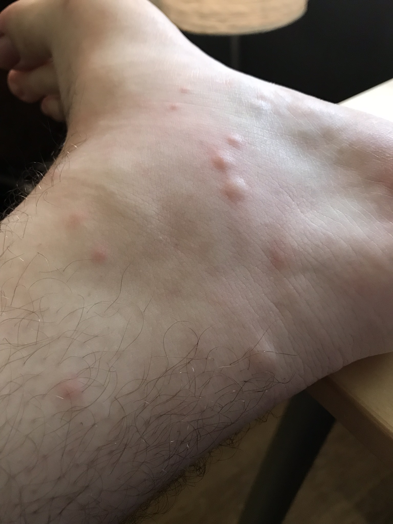 Bug bites