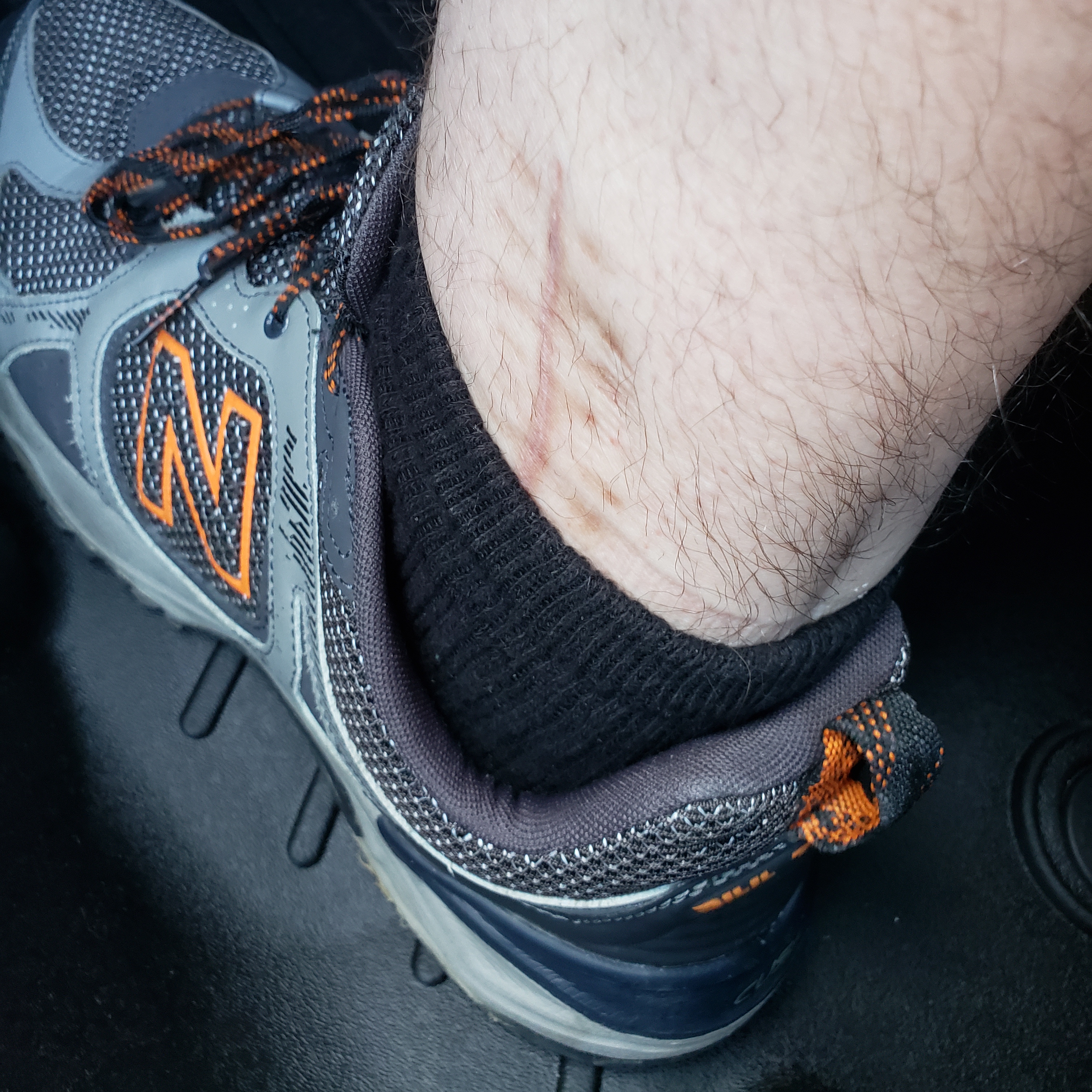 My scar showing above my shoe